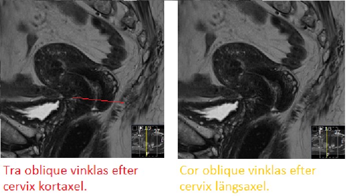 Cervix anatomi variant vinkling